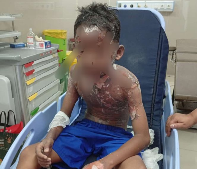 
					Bocah meninggal lantaran akibat main mercon spirtus (Dok/Ist)